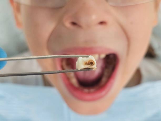 Best Emergency Tooth Extraction in Daphne, AL